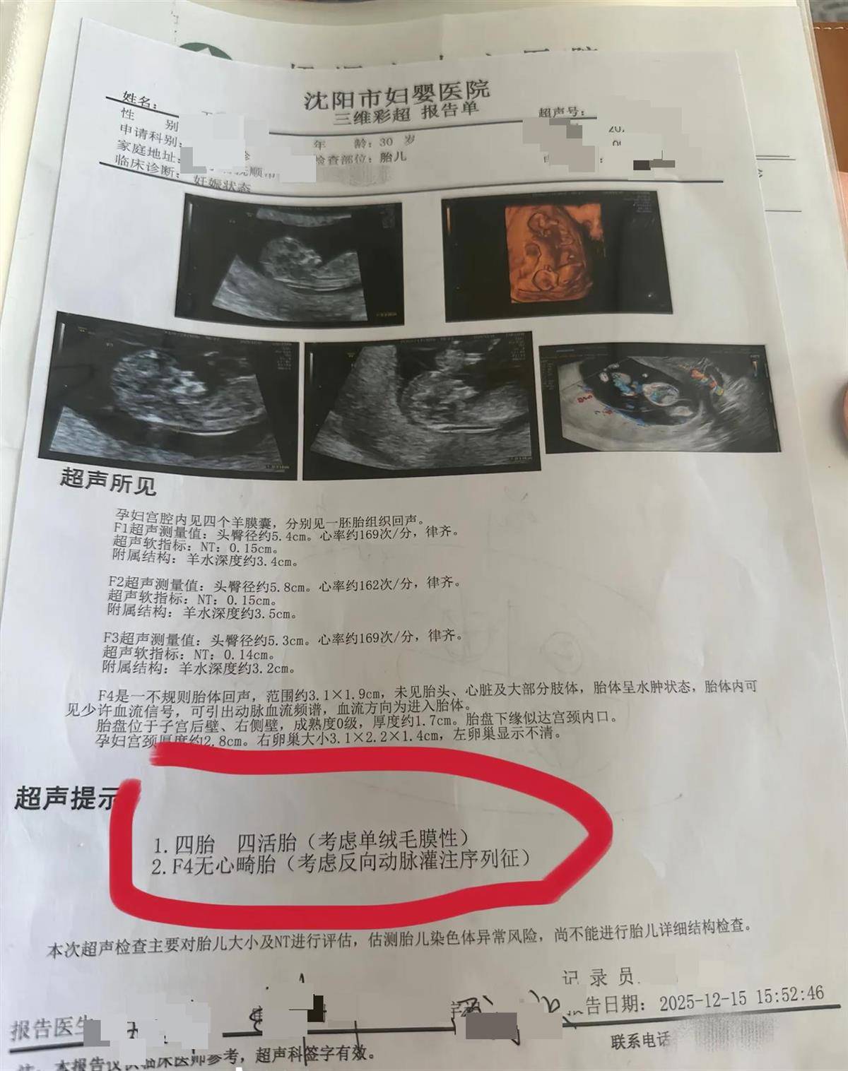 怎么开通皇冠信用开户_辽宁一孕妇两个月内从一胎变四胞胎怎么开通皇冠信用开户,每次产检发现多出一胎,医生:系同卵四胞胎,概率1300万至1500万分之一